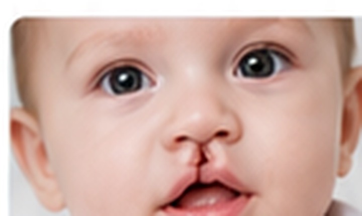 Cleft lip and palate surgery