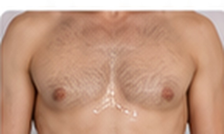 Gynecomastia surgery
